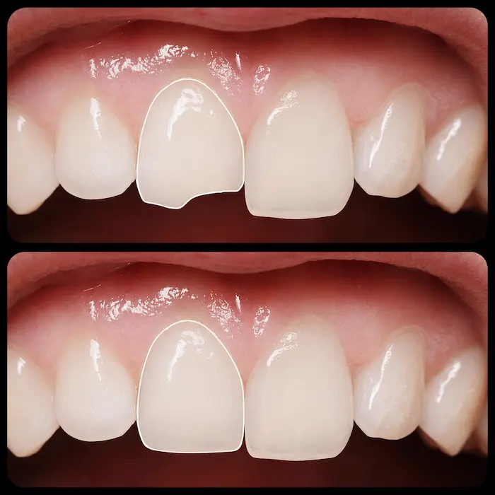 Dente quebrado