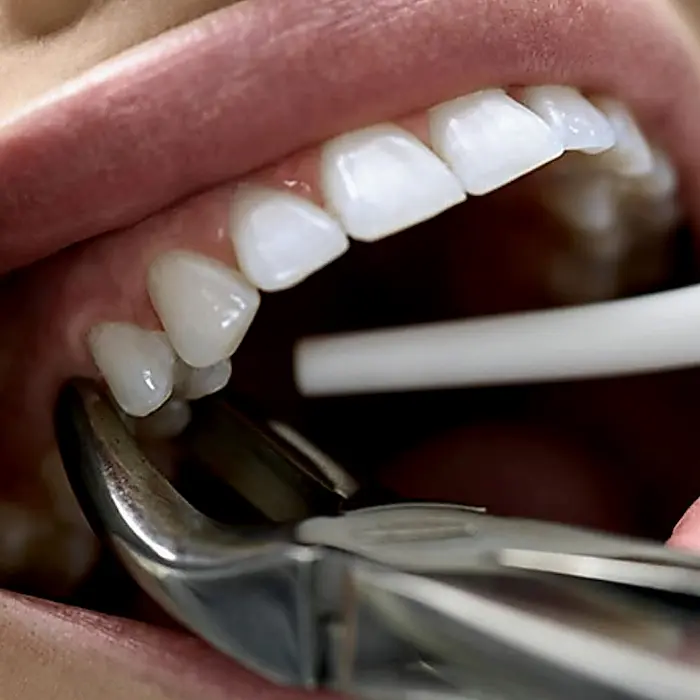 Extração de dente em Fortaleza