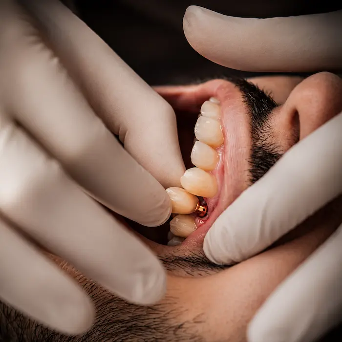 Implantes dentários em Fortaleza